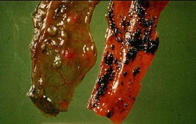 Tyzzer's disease Tyzzer's disease