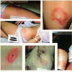 Images of erythema migrans rashes in humans