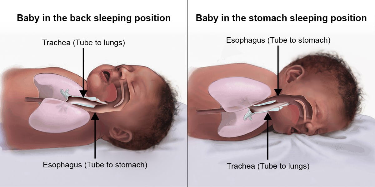 Baby Choking Diagram Alternative Picture
