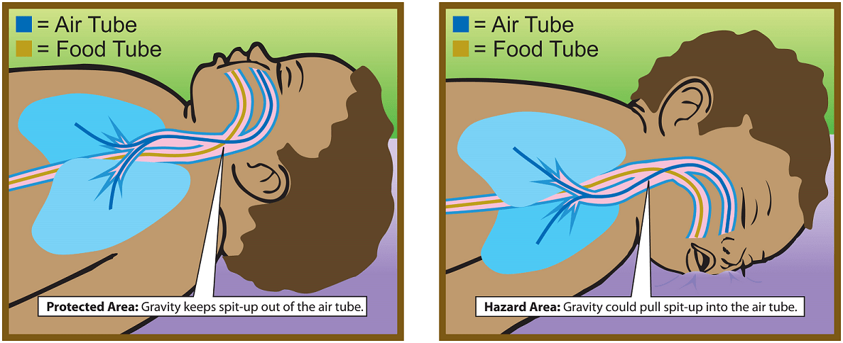 baby choking diagram